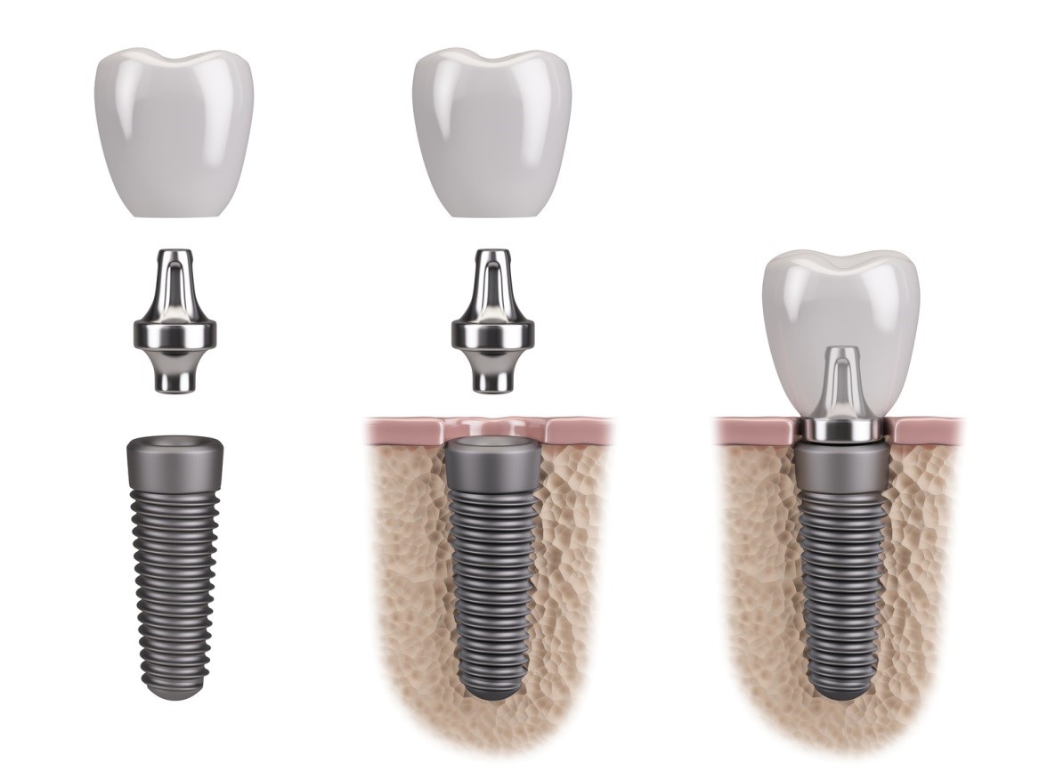 Abutment aus Titan oder Keramik