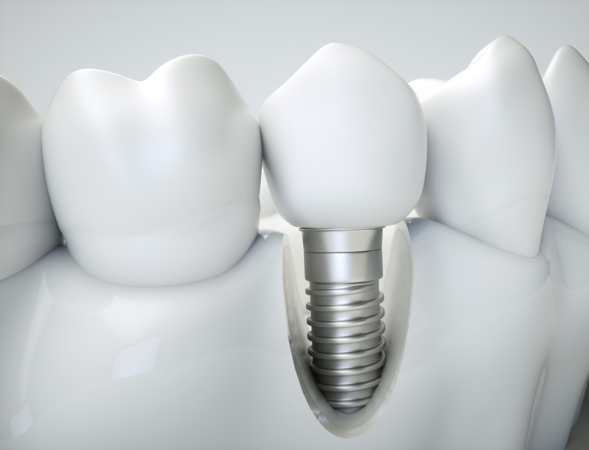 Implantatschraube – TiUnite™ Biomaterial