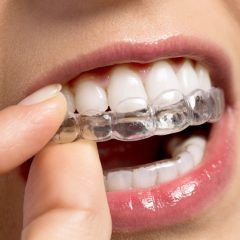 Invisalign ZÃ¼rich